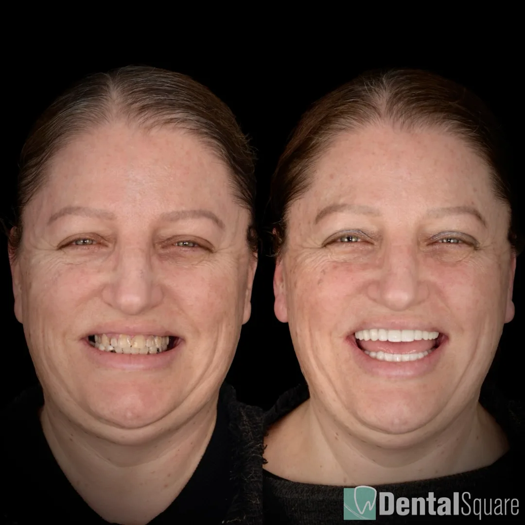 Before and after full-mouth dental implants by Dr Karim Habib