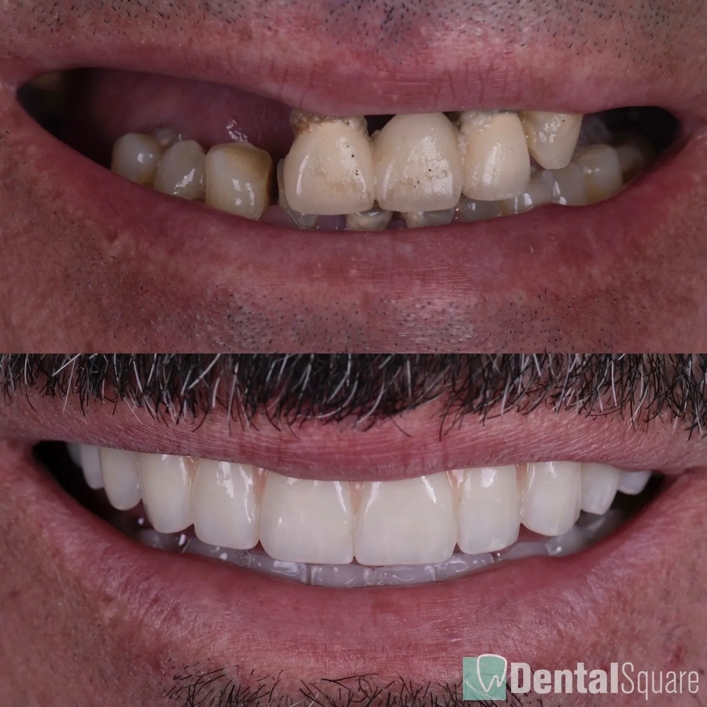 Close-up before and after of failing teeth restored with implants