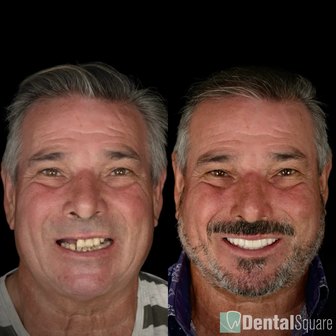 Before and after full-arch implant smile transformation