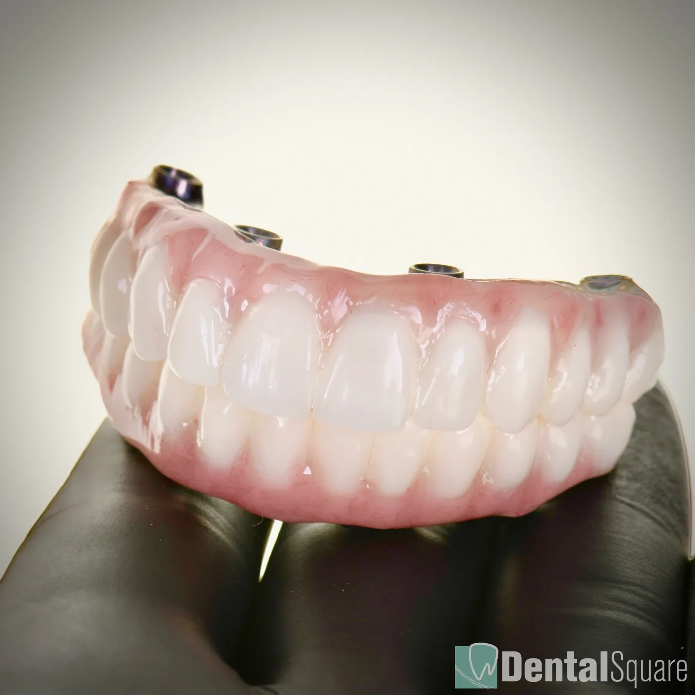 Hand-crafted zirconia full-arch prosthesis