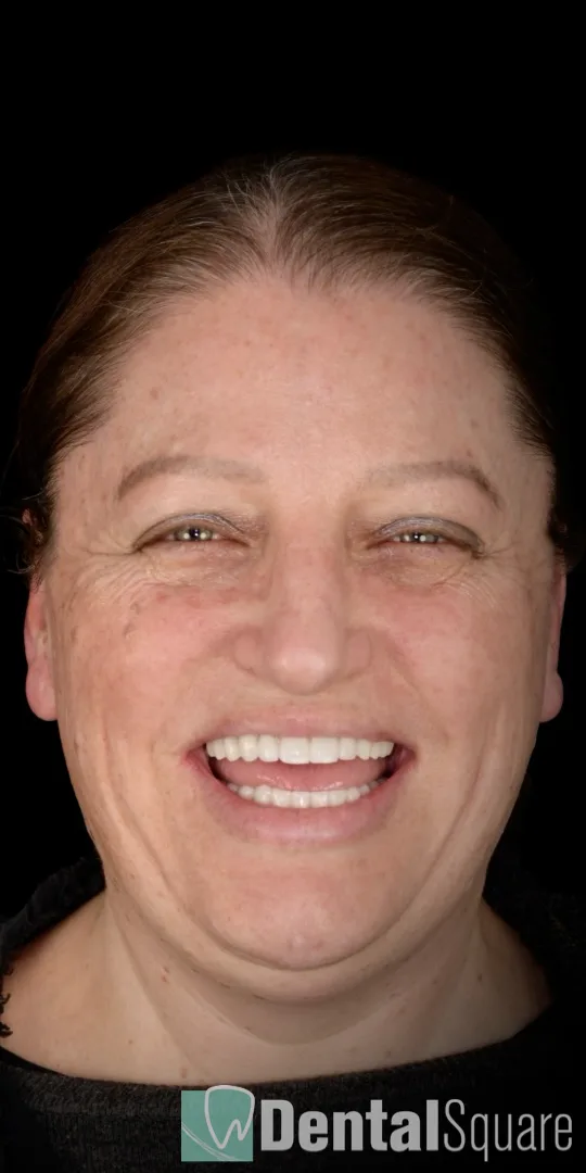 Dental Square implant smile result on Instagram