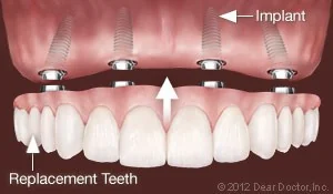 Implant-supported fixed replacement teeth