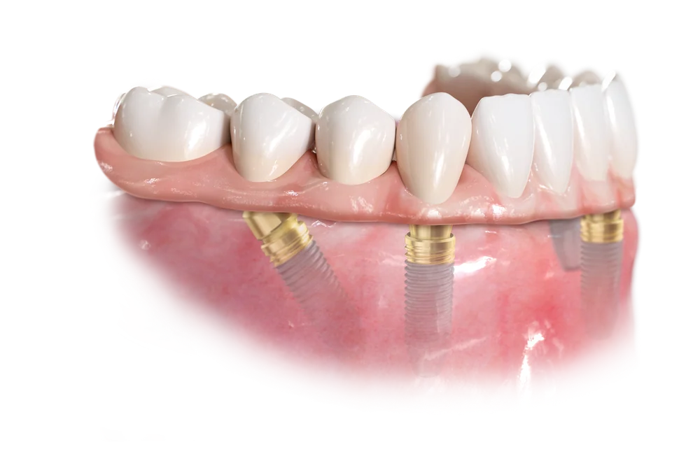 All-on-4 lower arch on four implants