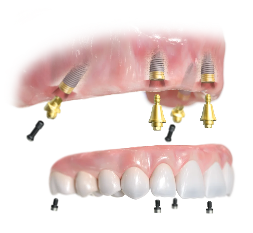All-on-4 upper arch components