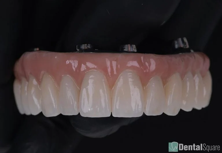 Upper All-on-4 zirconia prosthesis