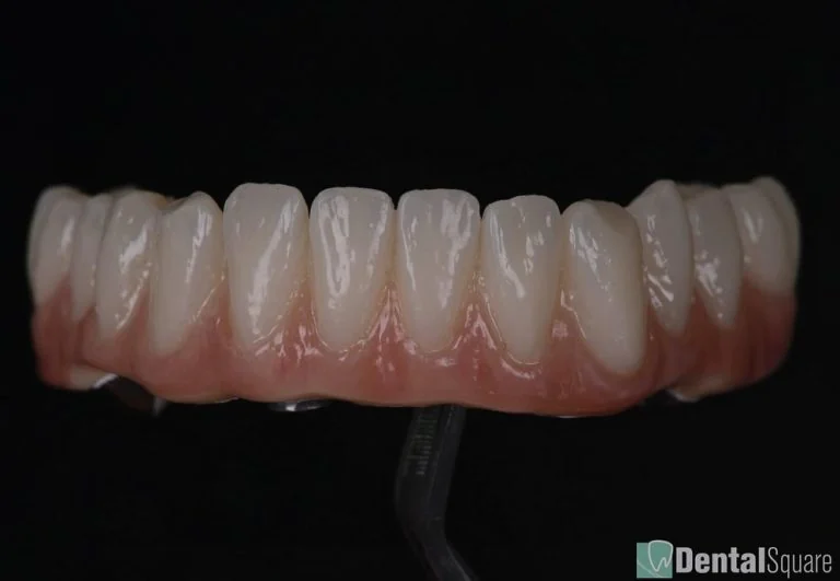 Lower All-on-4 zirconia prosthesis