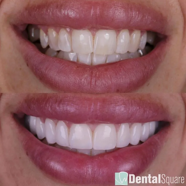 Glamorous smile makeover close up
