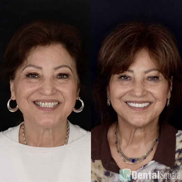 Before and after natural cosmetic enhancement