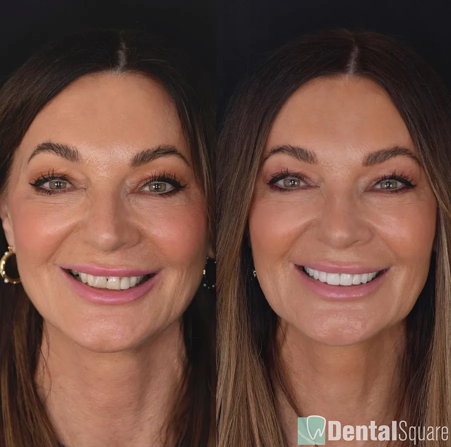 Real Dental Square patient before and after a cosmetic smile makeover