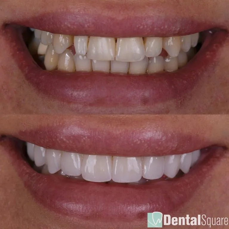 Custom porcelain veneers before and after