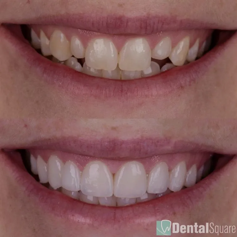 Porcelain veneers makeover before and after