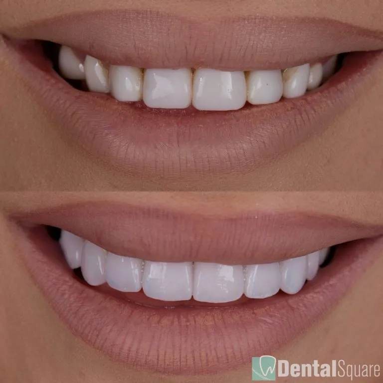 Old veneers replaced with new porcelain veneers