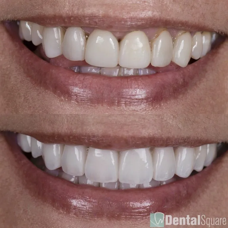 Porcelain veneers revision case before and after