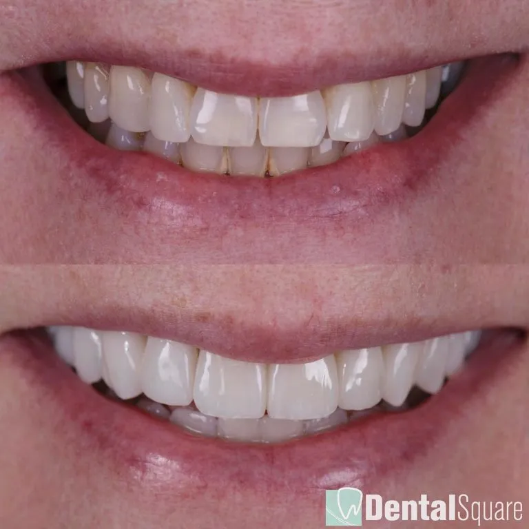 Ultra natural porcelain veneer enhancement close up
