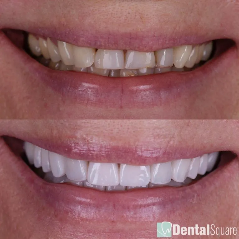 Upper and lower porcelain veneers before and after