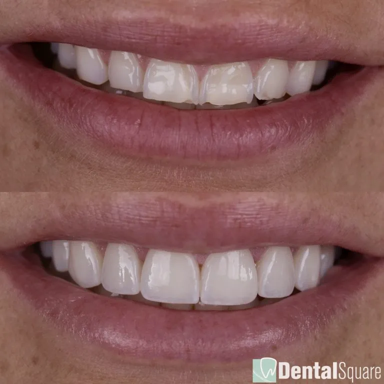 Severe wear and erosion treated with porcelain veneers