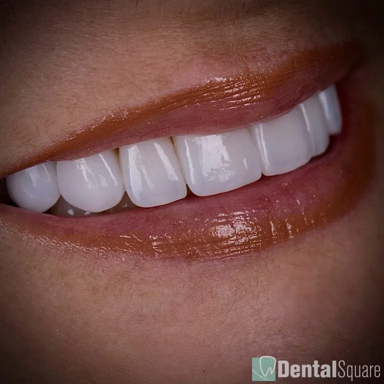 Close-up of ultra-natural porcelain veneers by Dental Square