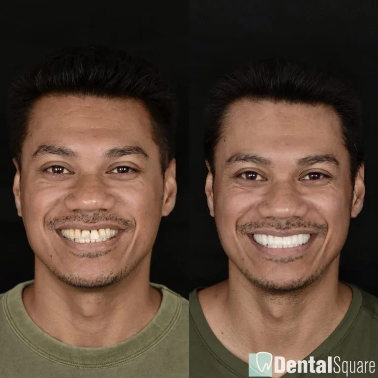 Before and after porcelain veneers, male patient full face