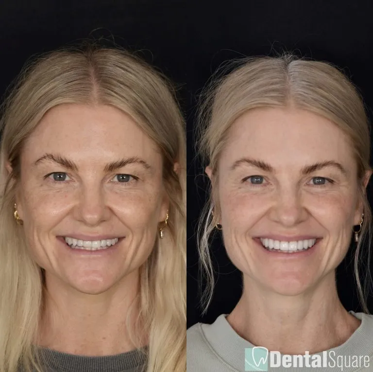 Before and after porcelain veneers, female patient full face
