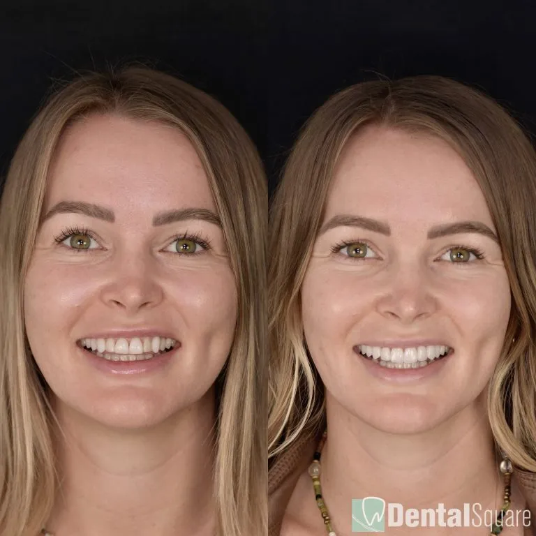 Before and after porcelain veneers smile makeover